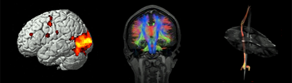 imágenes de resonancia magnética del cerebro